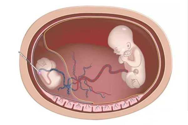 集安市助孕生子成功率_集安市成功案例最多的助孕公司_试管婴儿双胞胎减胎风